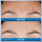 CeraVe Resurfacing Retinol Serum For Post Acne Marks, Formulated With Licorice Root Extract & Niacinamide, Brightening Serum & Pore Minimizer For Face, Post Acne Skin Barrier Repair, Non-Comedogenic - Image 4